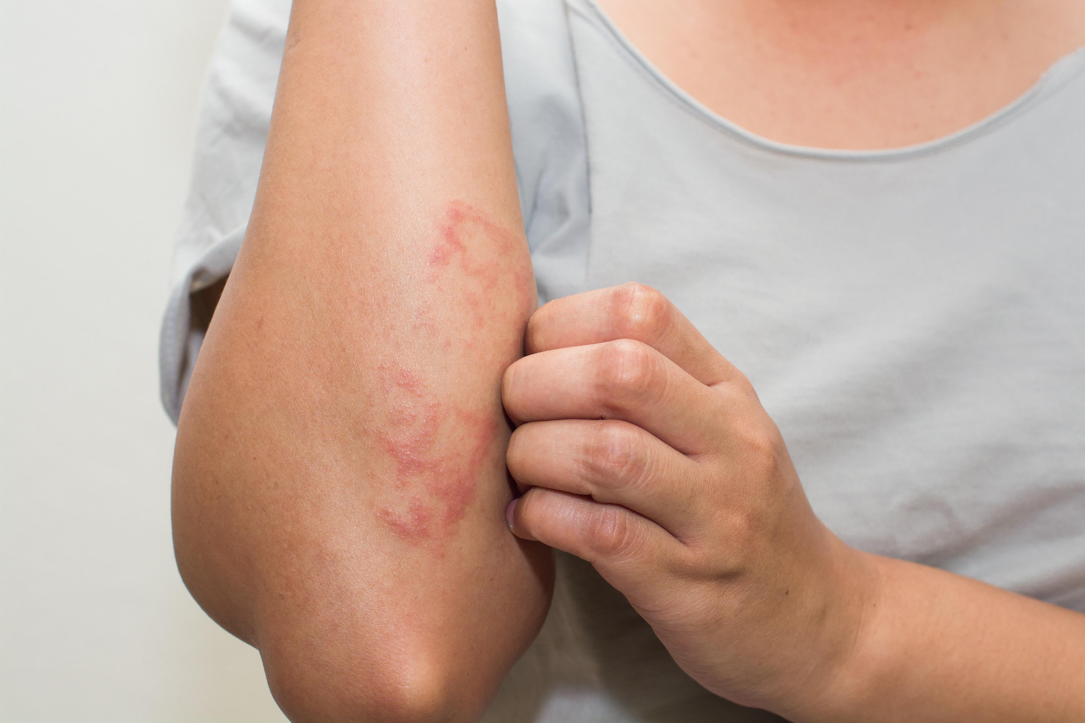 Eczema Treatment
