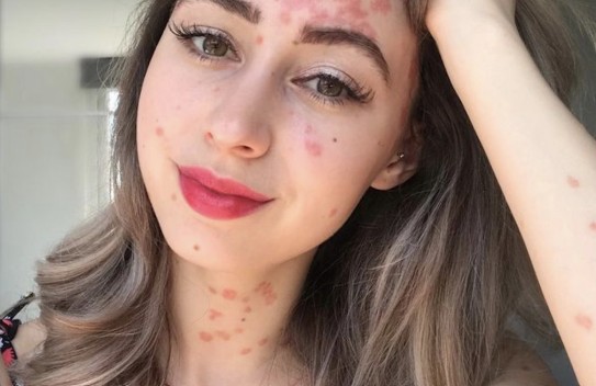 Psoriasis Treatment